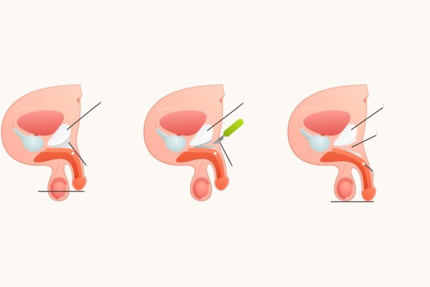 Ligamentotoomia peenise suurendamiseks