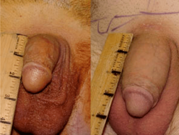 Enne ja pärast lipofillingut ja geeli implanteerimist